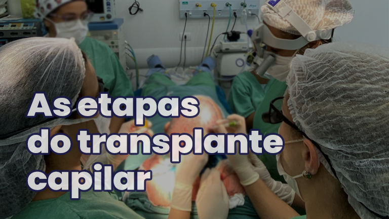 Conheça as etapas do Transplante Capilar
